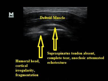 Ultrasound_Complete_Rotator_Cuff_Rupture_NJ_Sports_Medicine.jpg