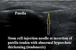 Stem_cell_injection_of_patella_tendon_Marc_Silberman_New_Jersey_Sports_Medicine_and_Perfor