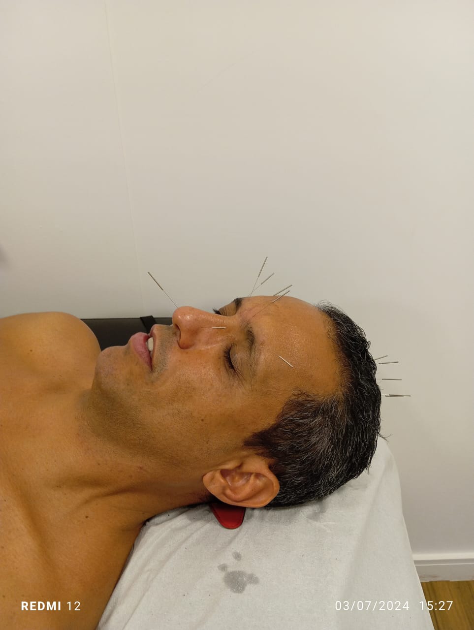sessão de acupuntura asa norte, sessão de acupuntura asa sul, tratamento acupuntura, tratamento acupuntura asa norte, tratamento acupuntura asa sul, tratamento acupuntura dor nas costas