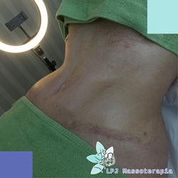 drenagem pos operatorio