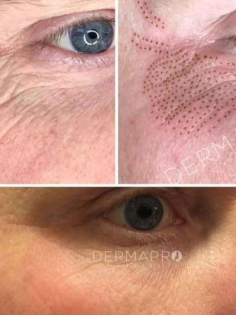 Plasma Fibroblast Skin Tightening Mysite