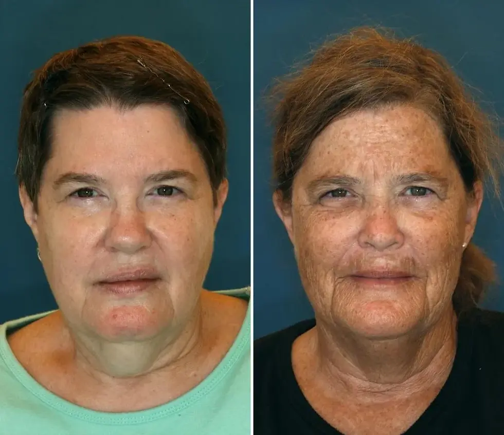Sunscreen vs. No Sunscreen
