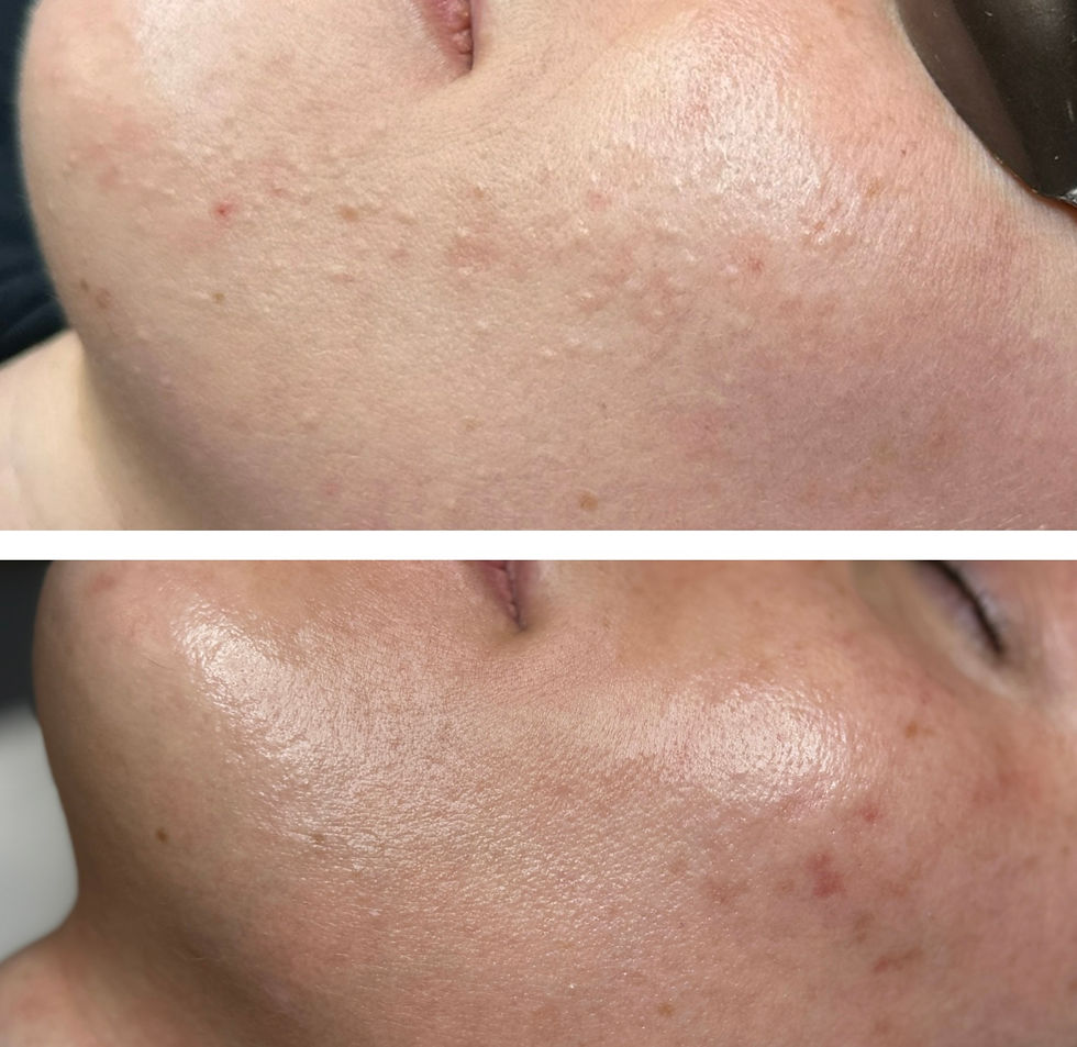 Acne Progress Picture
