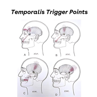 Temporalis Trigger Points