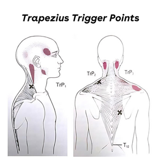 Trapezius Trigger Points