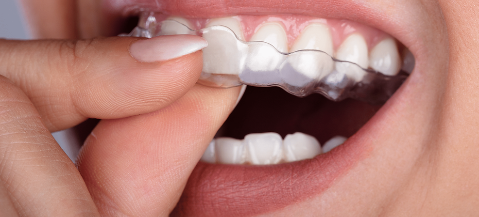 Clear-Correct-ALigners.png