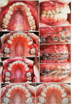 Case of Mini Implants