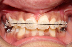 Esthetic Braces (Ceramic)