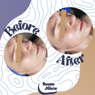 before and after of facial