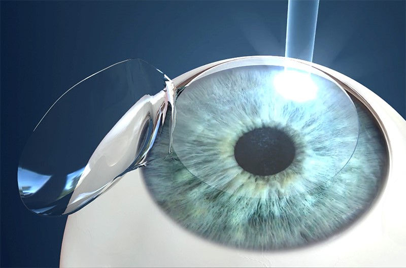 lasik.jpg