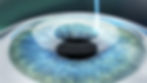 Lasik_Step_1.jpg