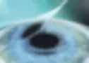 lasik-flap.webp