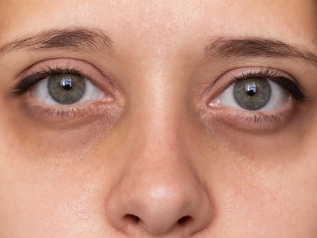 A Girl eyes with Dark Circle