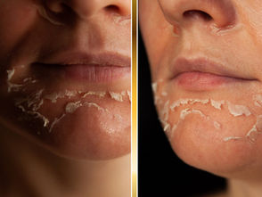 Chemical Peels in the Texas Summer: What Houston Clients Should Know