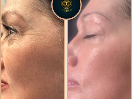 Why Skin Resurfacing & Pixel Laser Are Winter Essentials at Tu Es Belle Spa💙