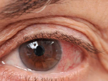 Glaucoma
