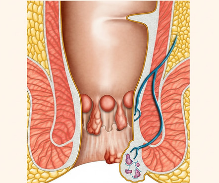 Thrombosis informative diagram by Pileshub Hospital Kolhapur