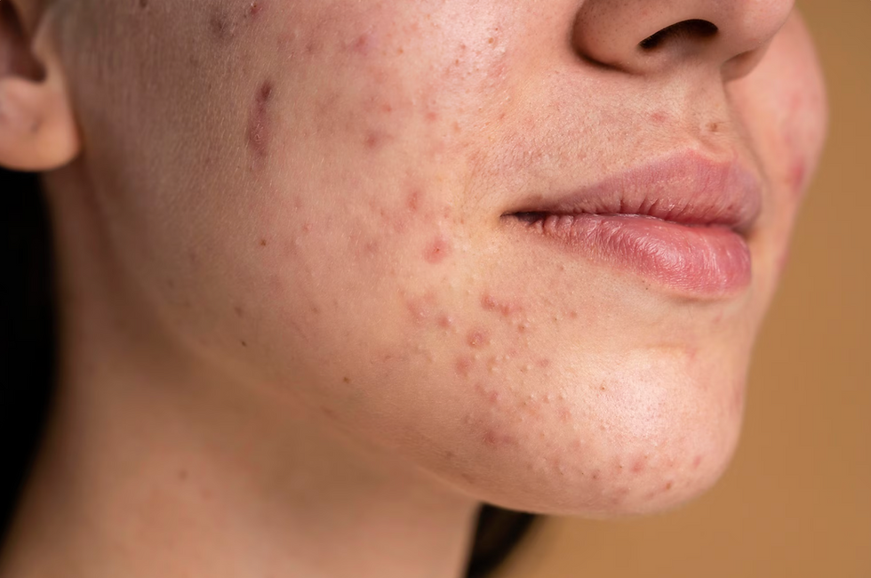 woman with acne on her face