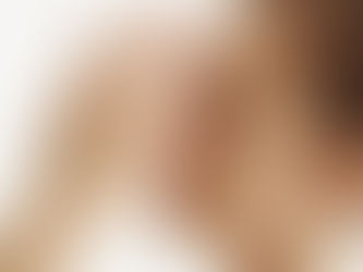 Downtime in Juvelook treatment and factors influencing recovery time