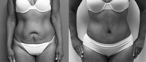 TUMMY TUCK