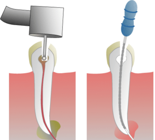 Tx of Failing Root Canals