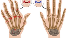 Artritis Reumatoide (AR)
