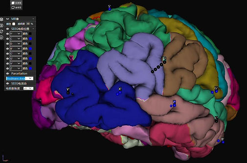 SEEG fusion visualization: cortical parcellation and intracranial electrode contacts. Product interface from the operation manual.