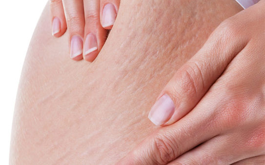 TÌm hiểu nguyên nhân gây ra rạn da