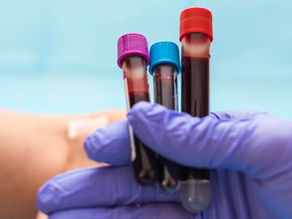 Novo Exame De Sangue Pode Detectar Alzheimer 25 Anos Antes Dos Sintomas