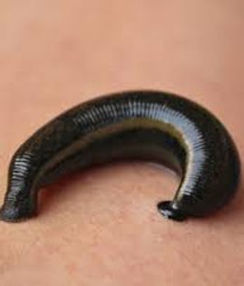 Explore the benefits of leech therapy at our nearby Ayurvedic clinic, a time-honored treatment for enhancing circulation and detoxification. Our experienced practitioners ensure a safe and effective approach in a calm, professional environment. Experience the healing potential of this traditional therapy today.