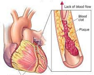 Heart with CAD_edited.jpg