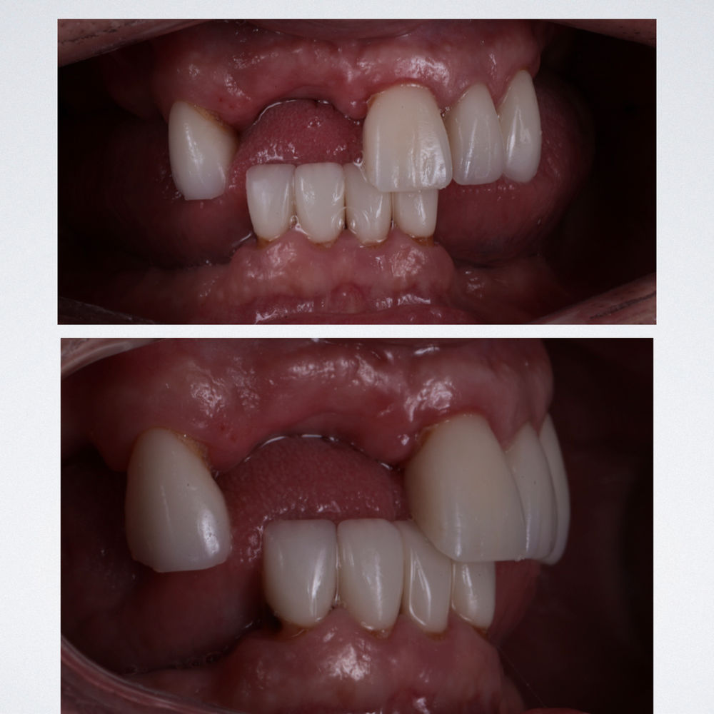 Flapless full mouth implants rehabilitation Immediate loading with 4