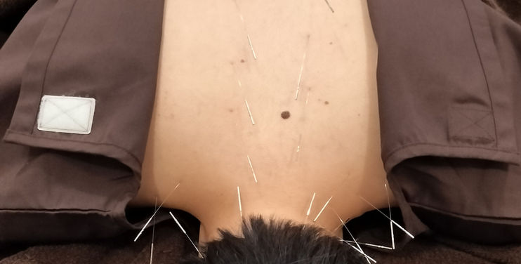 女性の後頭部に鍼が打たれている様子。体の内側から整える経絡治療の施術風景。