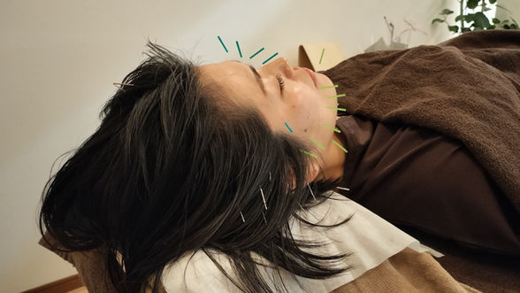 仰向けの女性の顔と頭に美容鍼が刺さっている