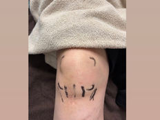 膝に触診の時にチェックするポイントを線でマークしてある