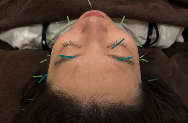 美容鍼を頭方向から見ている。目の周りと頬とフェイスライン、頭に鍼が刺さっている。