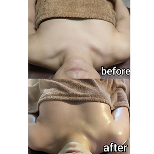 バザルト®ストーントリートメント施術後のデコルテ・胸元beforeとAfter|ハリ・ツヤが改善した状態|旭市サロンTorus