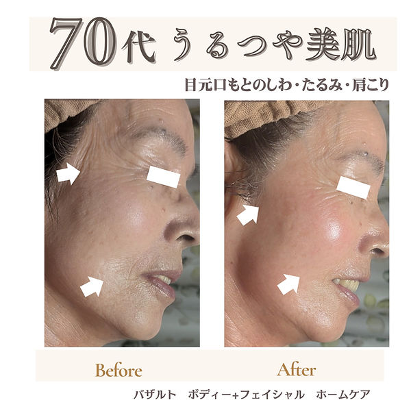 千葉県旭市Healing Salon Torus｜70代お客様のフェイシャルBefore/After。バザルト®ストーンボディ＋フェイシャル＋ホームケアで、目元・口もとのしわ・たるみが改善し、ふっくらハリのあるうるツヤ美肌へ。※効果には個人差があります