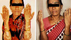 Skin Disease: Need No Scar Life Now