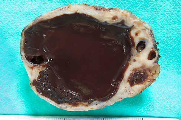 endometrioma (çikolata kisti), endometriyozis hastalığında görülen bir kisttir.