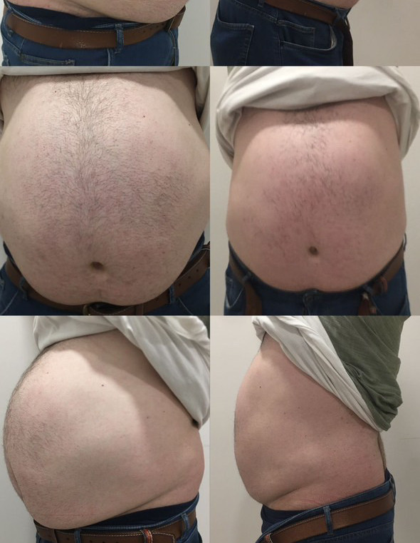 erkek karın bölgesi incelme.jpg