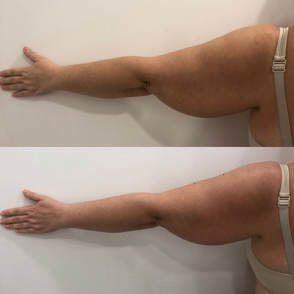 kadın kol bölgesel incelme.jpg