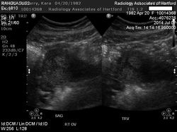 First Trimester