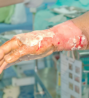 Treatment for Burns in Burlington