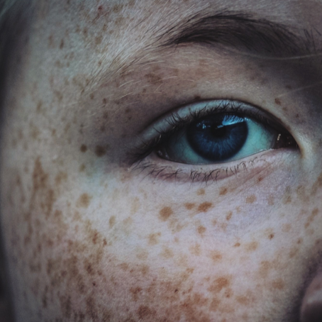 Why do some people have freckles?