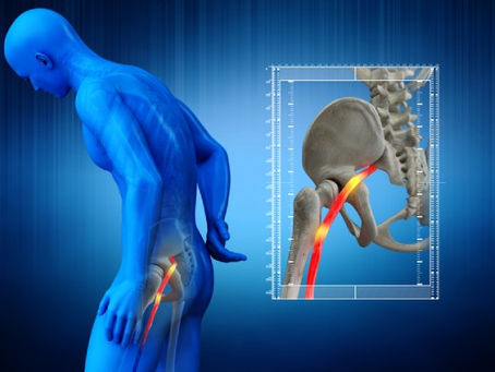 Sciatica vs. Back Pain: How to Tell the Difference