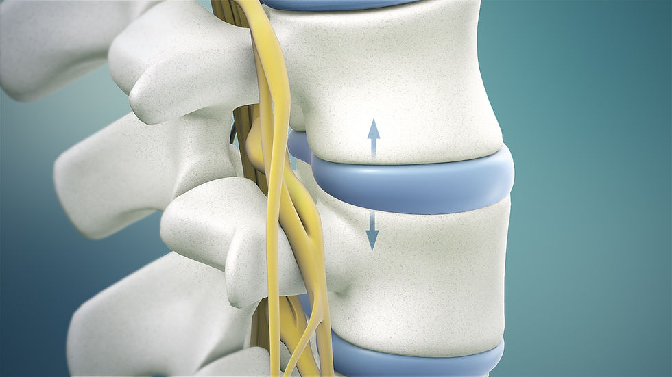 Who Is a Good Candidate for Spinal Decompression Therapy?