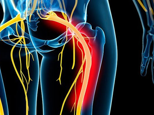 What Is Sciatica? Low Back Series: Part 1