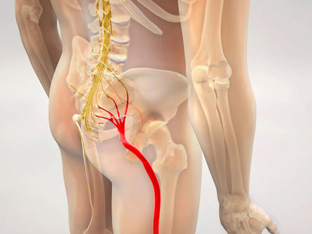 Low Back Pain vs. Sciatica: How to Tell the Difference