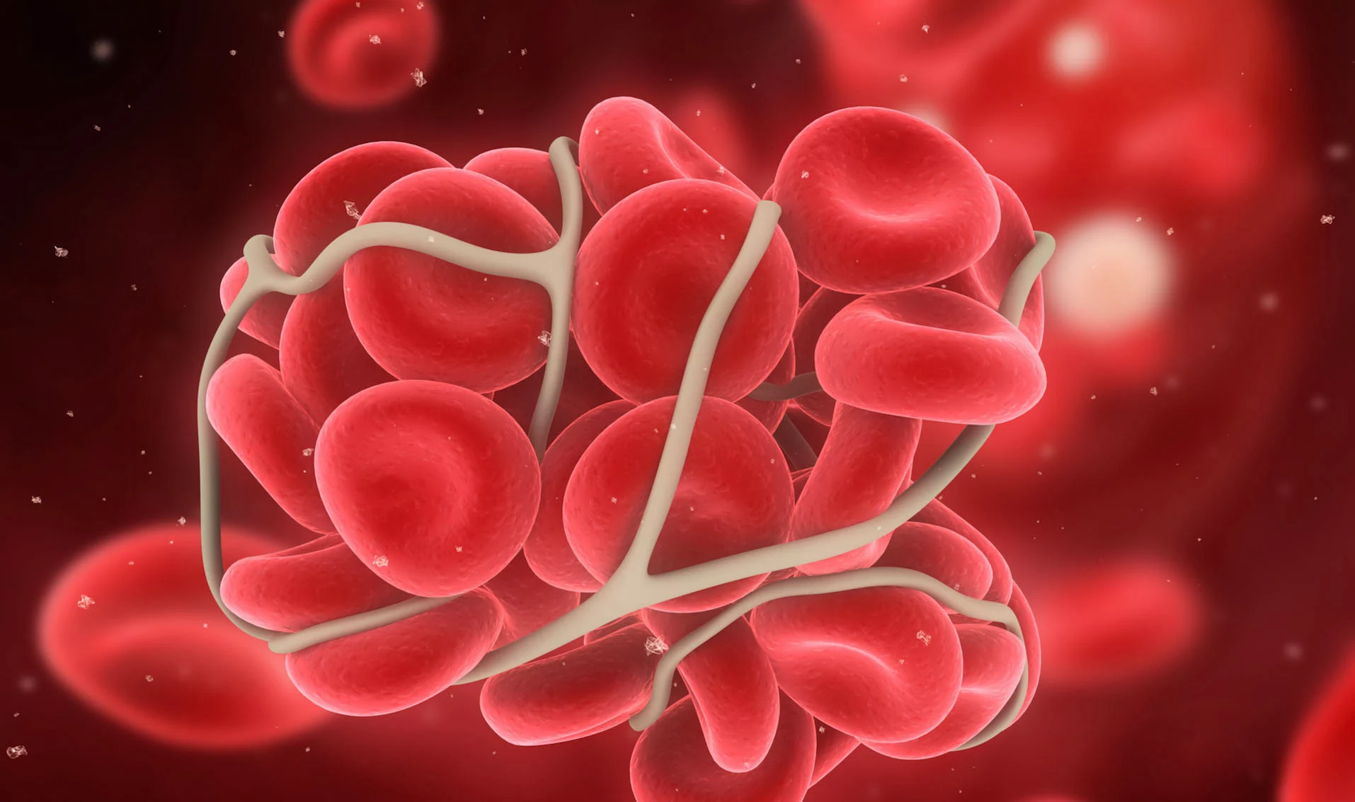 DLBCL.webp